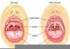 Strep Throat Medicine Image