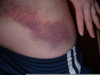 Hip Bruises Tumblr Image