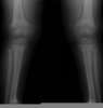 Xray Knee Normal Image