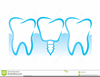 Dental Implant Clipart Image