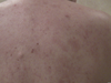 Candida Skin Back Image