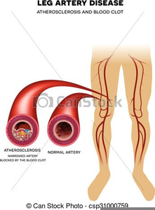 Coronary Artery Disease Clipart | Free Images at Clker.com - vector