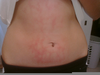 Heat Rash Stomach Image