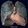 Smokers Lung Picture Image