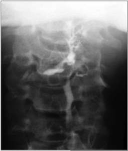 Thyroglossal Fistula Radiology Image