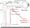 Horners Syndrome Anatomy Image