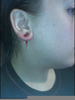 Ear Gauge Infection Image