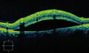 Retinal Detachment Oct Image