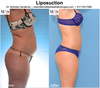 Thigh Liposuction Scars Image