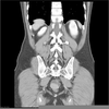 Villous Adenoma Radiology Image