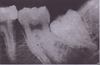 Dilacerated Root Extraction Image